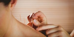 Foto de mãos colocando agulhas de acupuntura para dor no ombro de uma pessoa