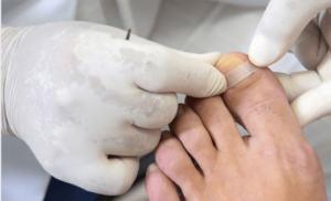 foto de mãos de uma podóloga aplicando uma órtese na unha de um paciente