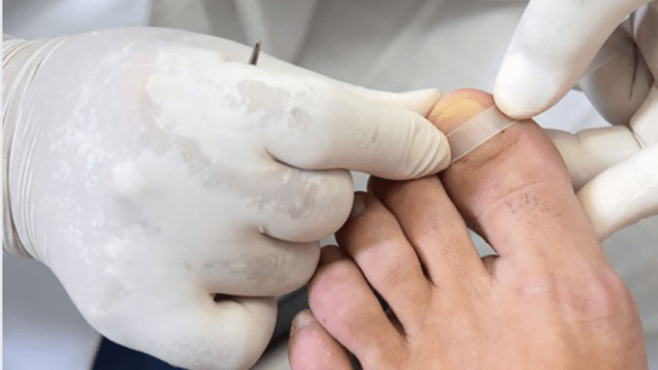 foto de mãos de uma podóloga aplicando uma órtese na unha de um paciente
